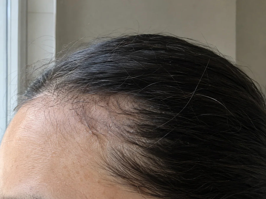 Tempe d'une femme aux cheveux tirés en arrière : la ligne des cheveux s'est éclaircie et une rangée de petits cheveux fins reste au bord du front